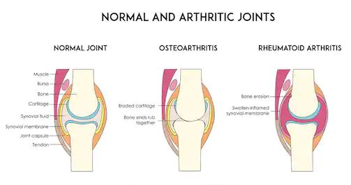 synovial liječenje artritisa)