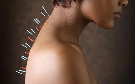 Akupunktura: bockanjem do vitalnosti i dobrog zdravlja - RTL ŽIVOT I STIL